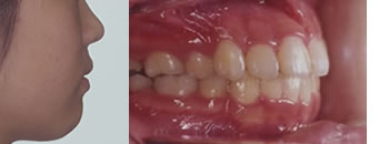出っ歯の矯正治療終了時
