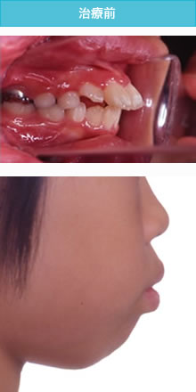 出っ歯の治療前