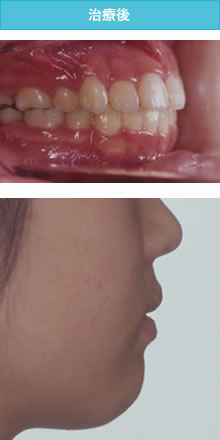 出っ歯の治療後