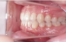 反対咬合（受け口）の１期治療後