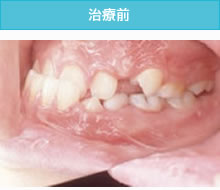 反対咬合（受け口）の治療前