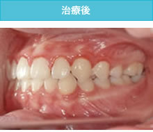 反対咬合（受け口）の治療後