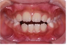 開咬合（オープンバイト）の治療前