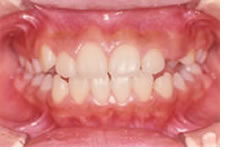 開咬合（オープンバイト）の１期治療後