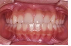 開咬合（オープンバイト）の治療終了後