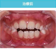 開咬合（オープンバイト）の治療前