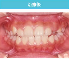 開咬合（オープンバイト）の治療後