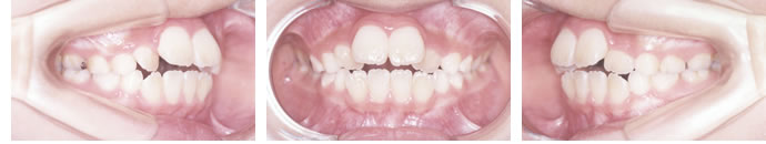 叢生歯列弓・開咬合の初診時