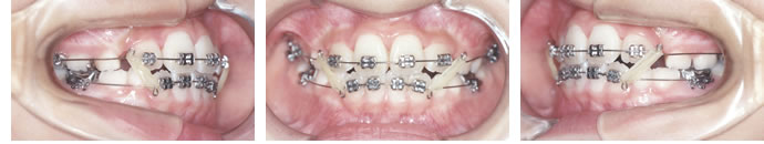 叢生歯列弓・開咬合の１期治療開始時