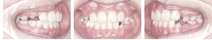 叢生歯列弓・開咬合の１期治療終了時