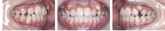 永久歯列の完成