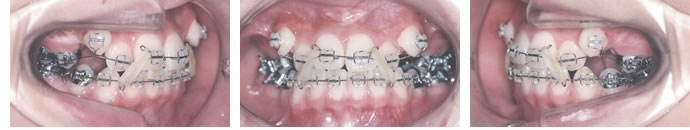叢生歯列弓・開咬合の２期治療終了時