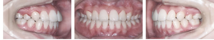 叢生歯列弓・開咬合の動的治療終了