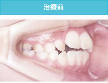 叢生歯列弓・開咬合の治療前