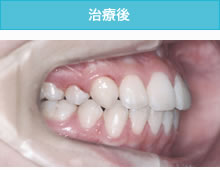 叢生歯列弓・開咬合の治療後