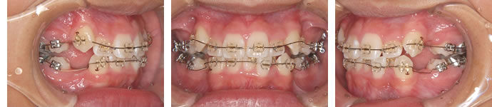 装置装着１ヶ月後