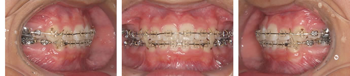 装置装着25ヶ月後