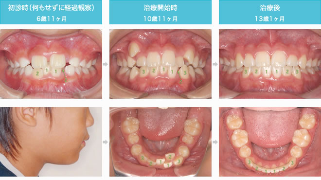 子供の矯正　叢生歯列弓の治療経過