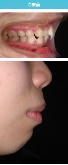 上顎前突・出っ歯の治療前