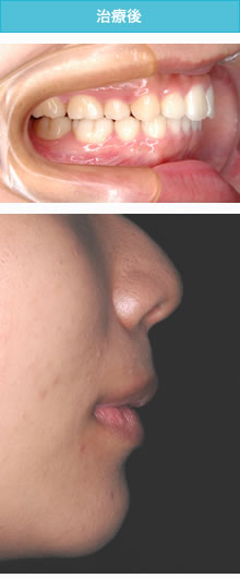 上顎前突・出っ歯の治療後