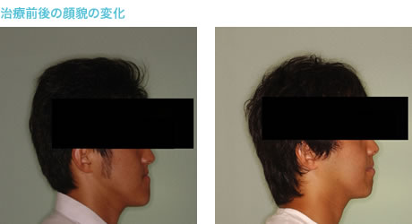 下突咬合治療後の顔貌の変化