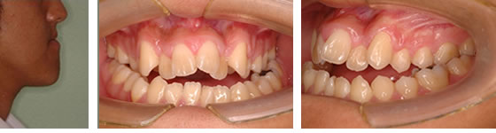 下突咬合の治療前