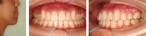 下突咬合の治療後