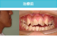 反対咬合・受け口の治療前
