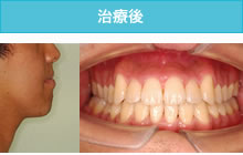 反対咬合・受け口の治療後