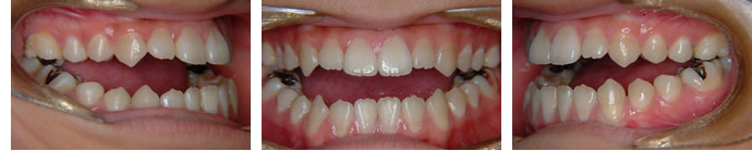 開咬合（オープンバイト）治療前の正面と左右