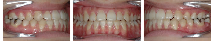 開咬合（オープンバイト）治療後の正面と左右