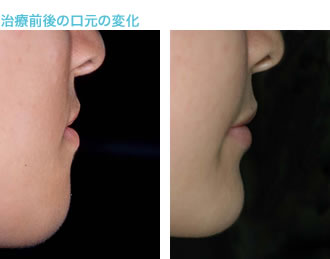 開咬合（オープンバイト）治療後の口元の変化