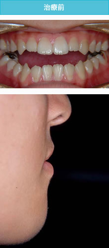 開咬合（オープンバイト）の治療前