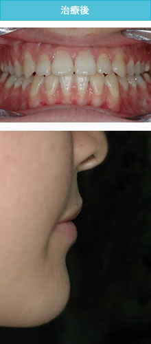 開咬合（オープンバイト）の治療後