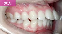 上突咬合（いわゆる上顎前突・出っ歯）せき矯正歯科医院
