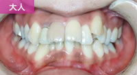 上突咬合（いわゆる上顎前突・出っ歯）せき矯正歯科医院