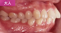 両突歯列（両顎の出っ歯）アイウエオ矯正歯科医院