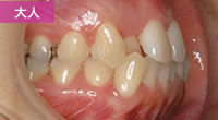 両突歯列（両顎の出っ歯）はまさき矯正歯科医院