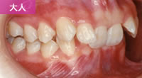 過蓋咬合（いわゆる垂直的に前歯部が深い咬み合わせ）ゆうだ矯正歯科医院