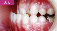 下突咬合（いわゆる下顎前突・反対咬合・受け口）ふかまち歯科矯正