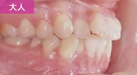 叢生（でこぼこの歯・八重歯・乱ぐい歯）星歯科矯正