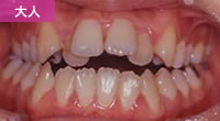 開咬合（オープンバイト）星歯科矯正