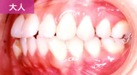 両突歯列（両顎の出っ歯）よごさわ歯科矯正