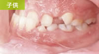 下突咬合（いわゆる下顎前突・反対咬合・受け口）星歯科矯正