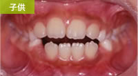 開咬合（オープンバイト）星歯科矯正
