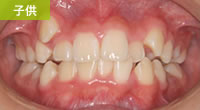 叢生（でこぼこの歯・八重歯・乱ぐい歯）はまさき矯正歯科医院