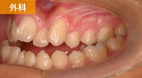 外科的矯正 受け口の症例 かない矯正歯科医院