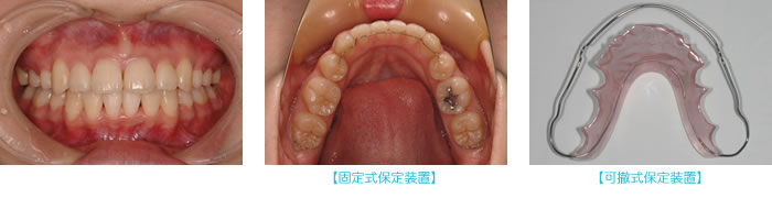 固定式保定装置と可撤式保定装置