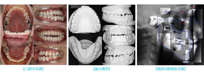 矯正治療開始前の検査
