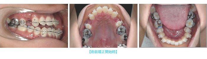 術前矯正開始時